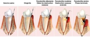 parodontie soin des gencives